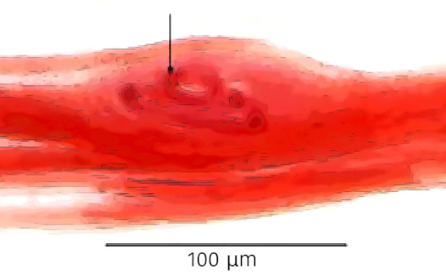 trichinella